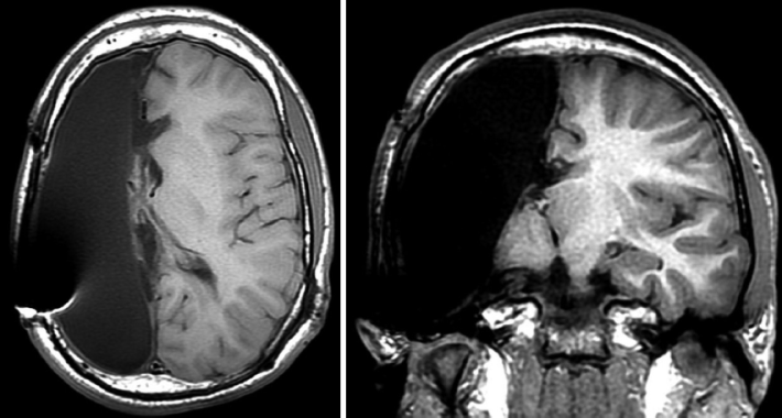 Скенер на пациент с тежка форма на епилепсия, на който почти изцяло е премахнато едното мозъчно полукълбо. Снимка: Sean M. Lew (Hemispherectomy in the treatment of seizures: a review)