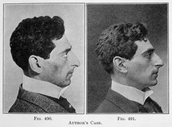 Козметичните операции на носа са популяризирани от еврейски мъже преди повече от век